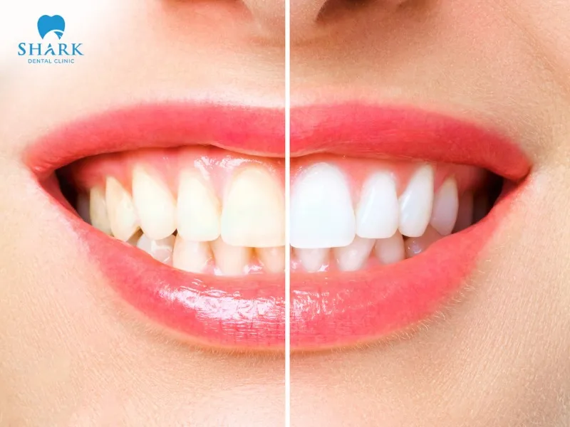 Tooth bleaching effectively breaks down the structure of stain-causing deposits on the teeth
