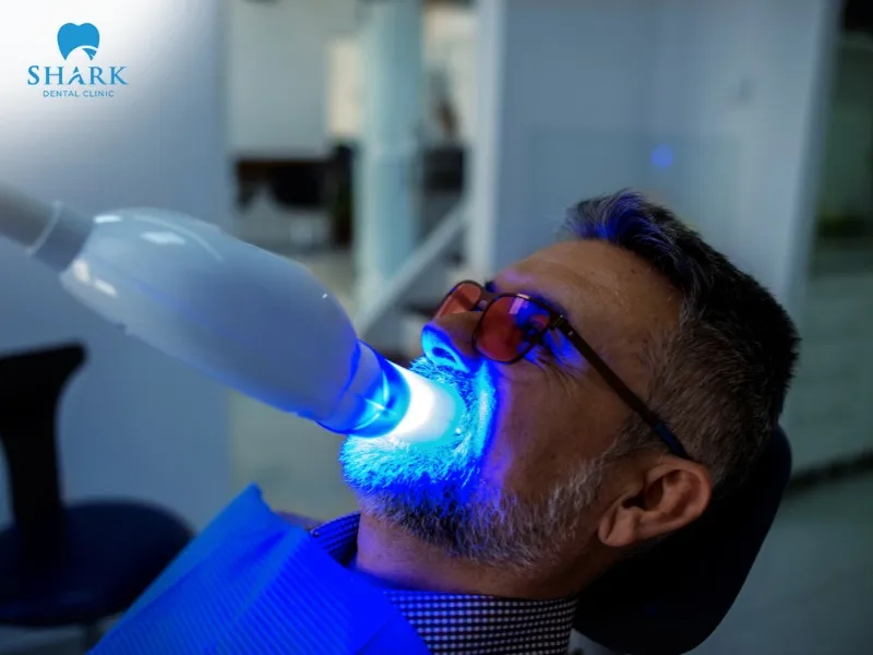 Dental bleaching performed at unqualified clinics can result in serious complications such as enamel damage and gingival irritation