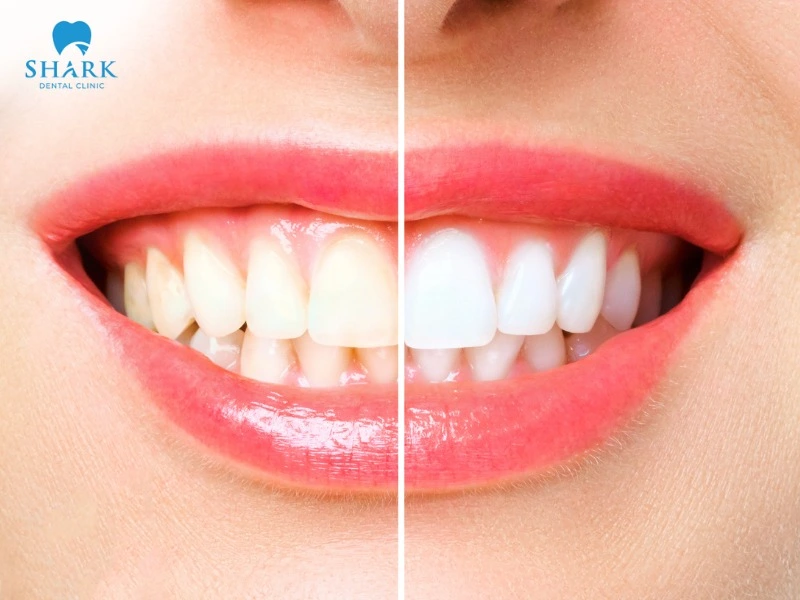 You should consider teeth whitening in Vietnam for its excellent aesthetic outcomes and cost-effectiveness