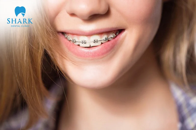 Orthodontic braces are a solution that helps teeth move into proper alignment along the dental arch