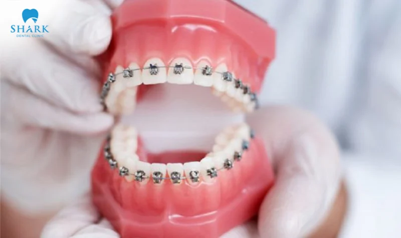 Traditional metal braces offer highly effective results in orthodontic treatment