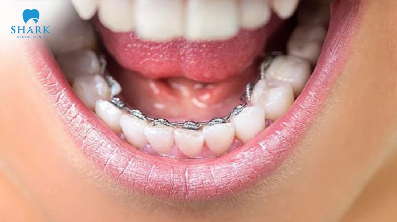 Lingual Braces