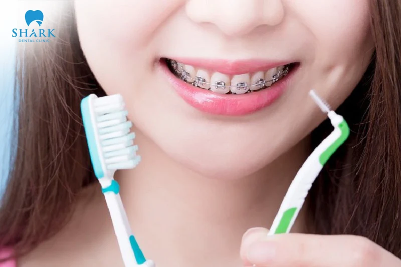 It is important to follow key guidelines for oral care and hygiene during the braces period