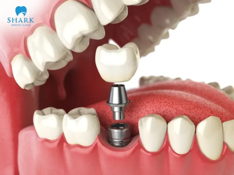 Dental implants are used to replace missing tooth roots and restore natural tooth function.