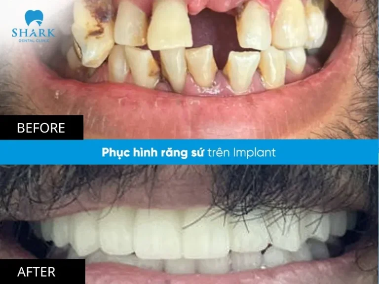 You can refer to several before-and-after images of dental implant treatments performed at our clinic: