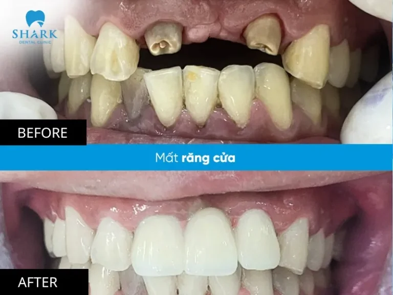 Dental Implant for Missing Front Tooth