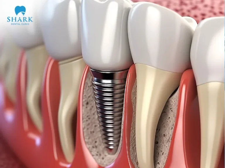 Dental implants do not invade or affect adjacent teeth.