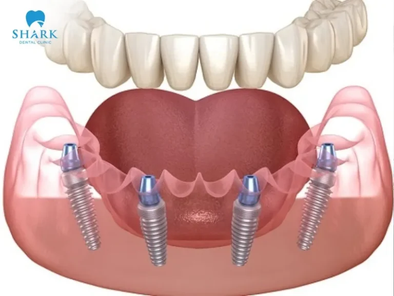The cost of All-On-4 dental implants in Vietnam is affordable