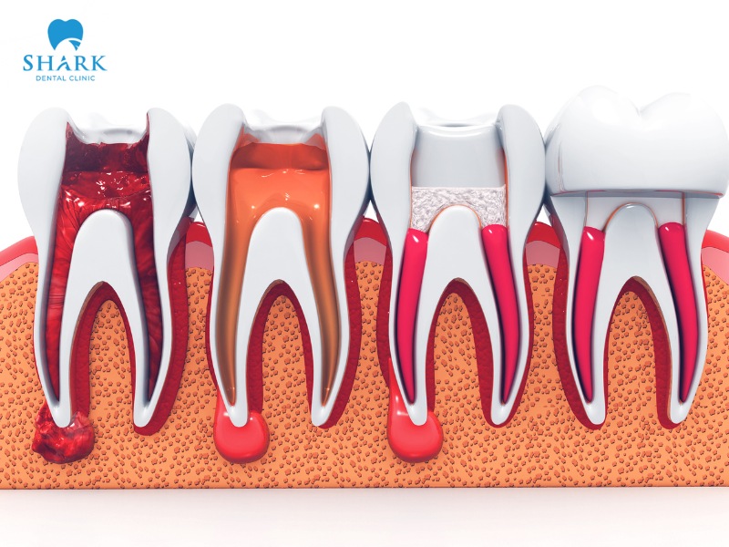 Root canal treatment is a procedure that removes inflamed pulp tissue to preserve the natural tooth and prevent the risk of infection spreading further