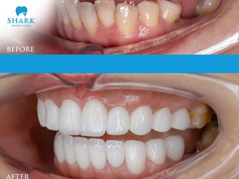 Porcelain crowns are an effective solution for addressing stained or yellowed teeth