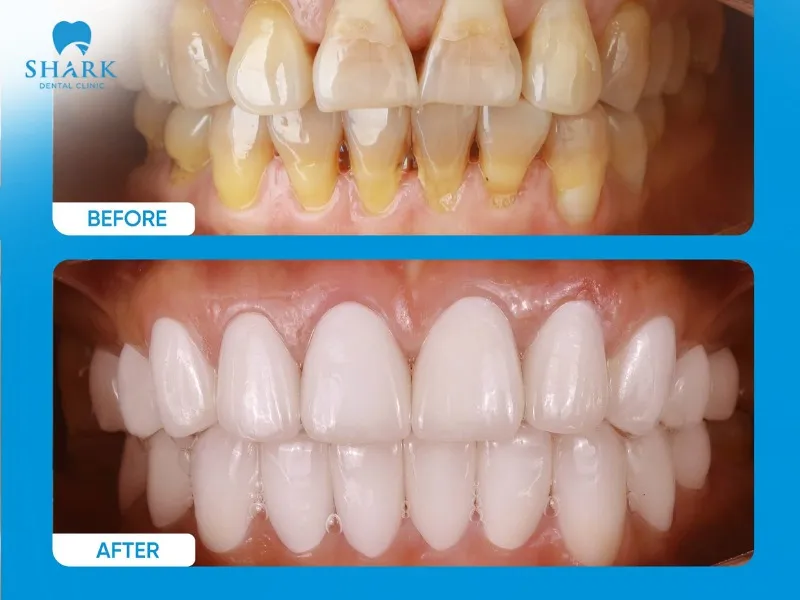 Dental clinics in Vietnam offer porcelain crown services that deliver outstanding aesthetic results