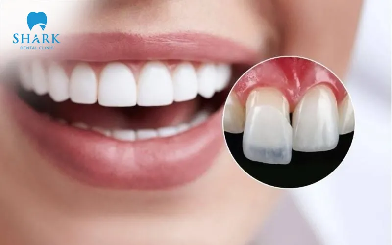 Porcelain dental veneers help create an even, beautiful tooth structure and a more confident smile