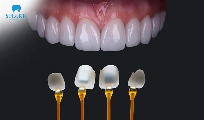 Porcelain veneers offer high aesthetic value, long-lasting durability, and excellent quality