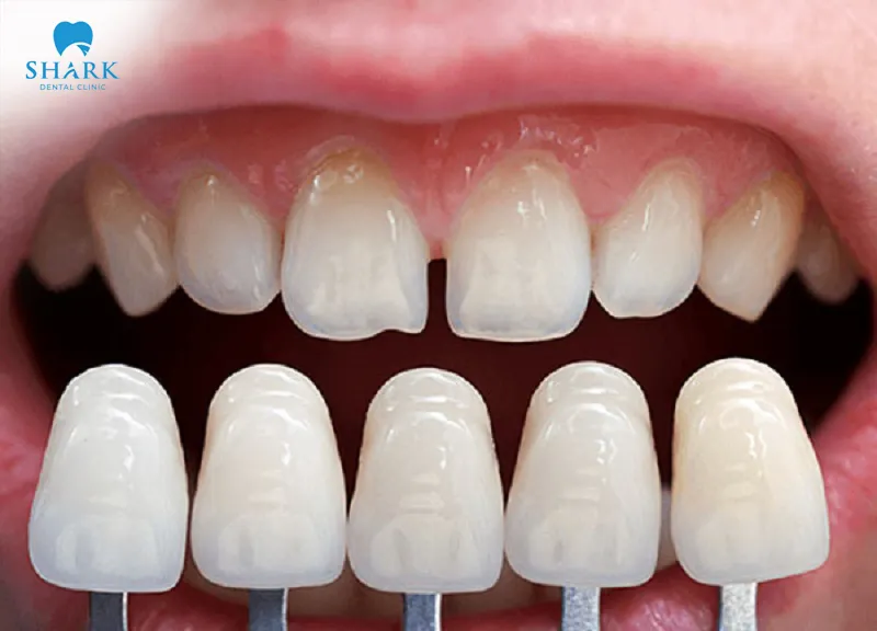 There are many types of dental porcelain veneers used in dentistry