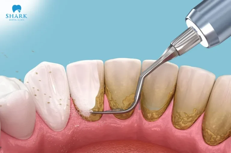 Scaling teeth is a dental technique used to remove hardened plaque from the tooth surface