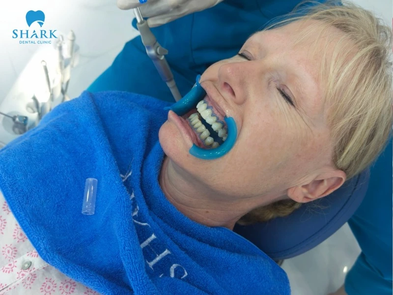 The cost of teeth whitening at dental clinics in Vietnam currently ranges from 11$ to 190$