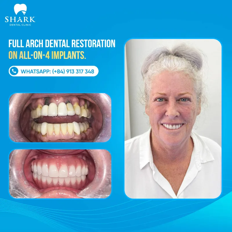 Shark Dental Clinic is a safe choice for All on X dental implants in Vietnam