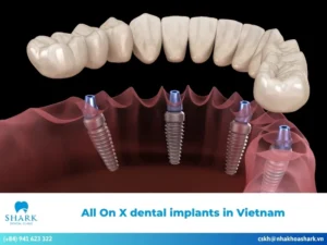 All on x dental implants in Vietnam