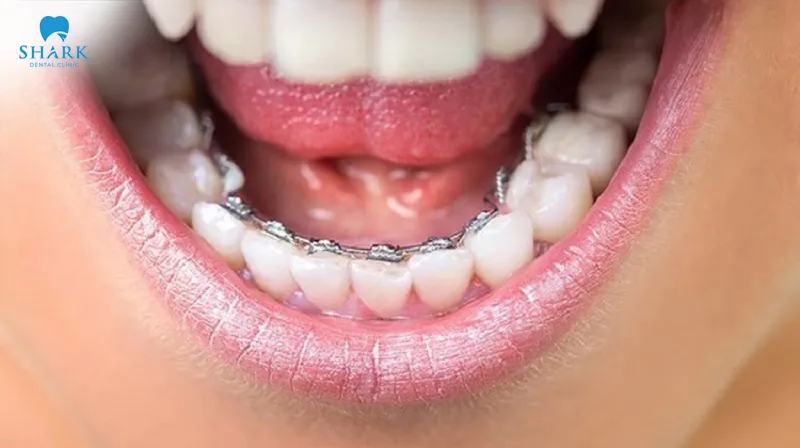 Lingual braces use concealed brackets placed on the inside of the teeth, offering high aesthetic value