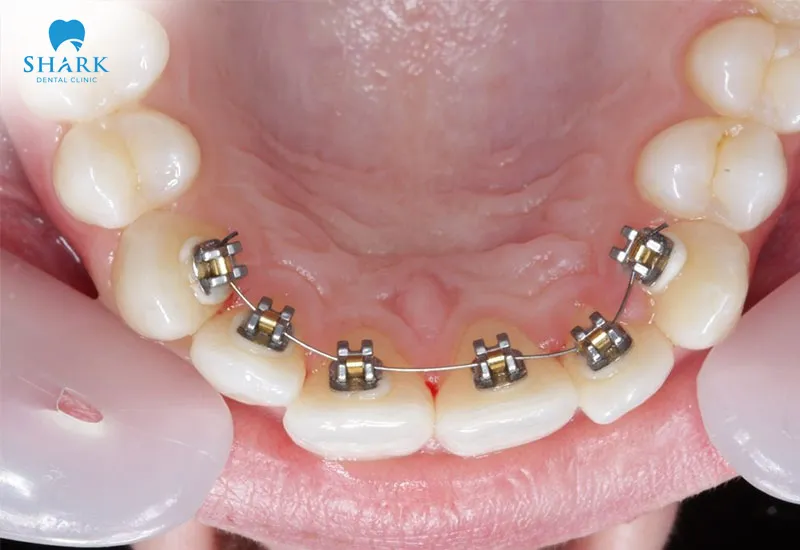Lingual braces provide high aesthetic value and ensure safety during treatment