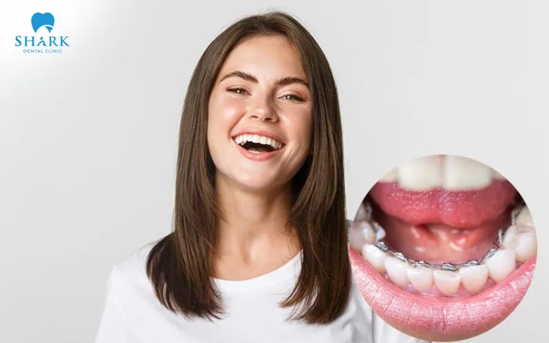 The cost of lingual braces is influenced by various factors