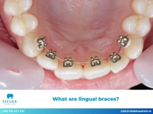 Lingual braces