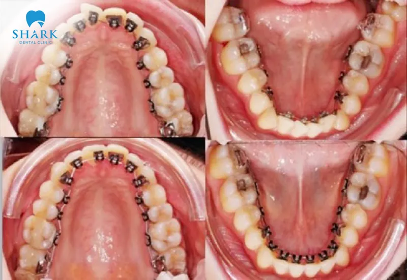 Lingual braces at Shark Dental ensure safety and effectiveness