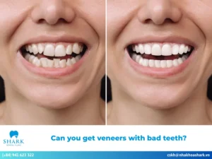 Can you get veneers with bad teeth?