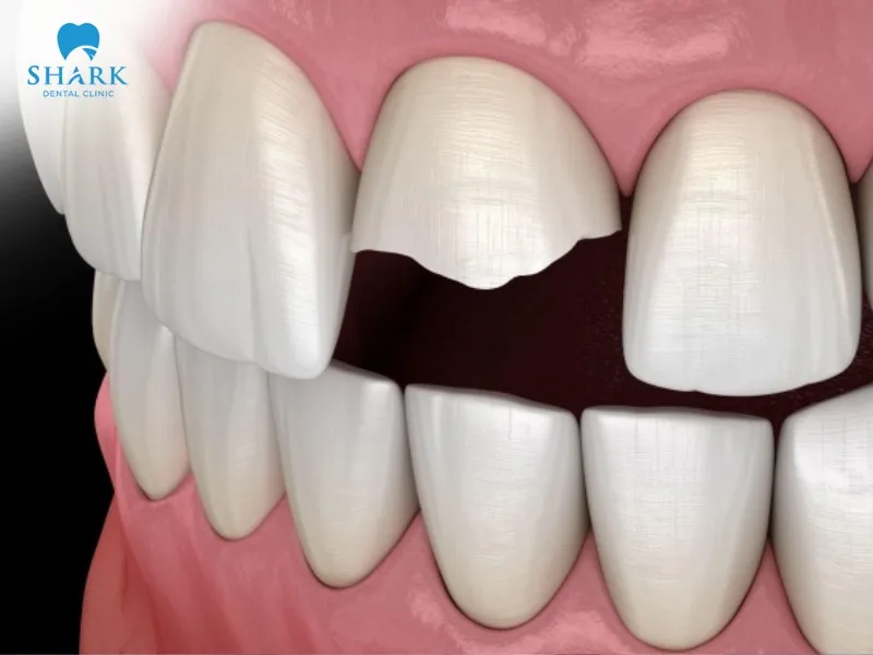 Chipped tooth crown can be caused by trauma or impact, low-quality crown materials, improper crown placement, and other similar factors