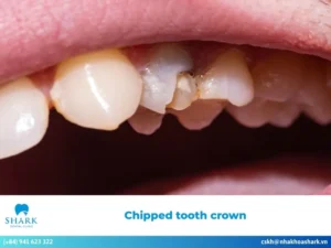 Chipped tooth crown