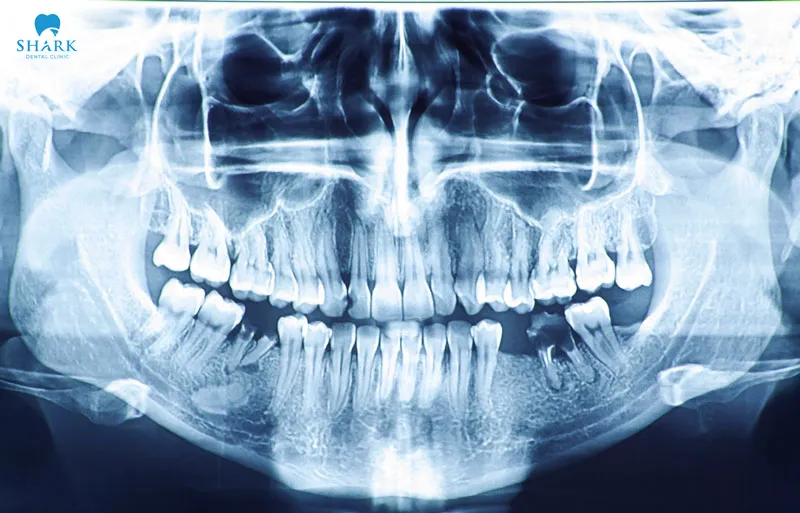 Dentists prescribe dental X-rays for specific cases as needed