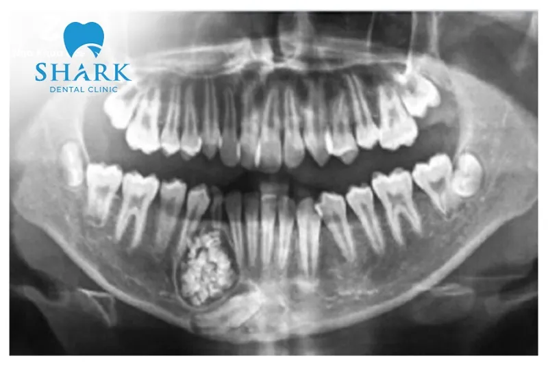 Dental X-rays should be taken within medically approved time intervals