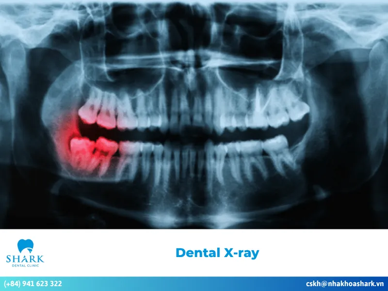 What are dental X-Rays?