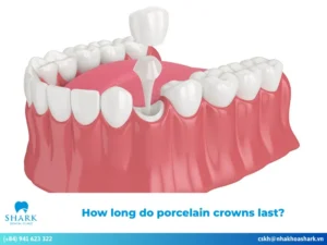 How long do porcelain crowns last?
