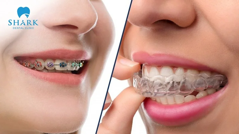 The duration of orthodontic treatment ranges from 12 to 24 months, depending on the method chosen