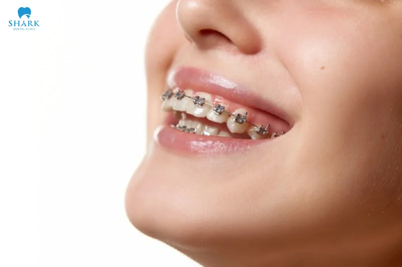 Braces are usually removed after 12 to 24 months, based on the treatment approach for each individual