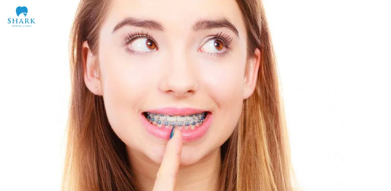 In the early stages after getting braces, you may experience some discomfort and mild pain