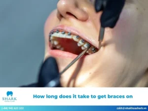 How long does it take to get braces on