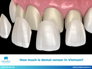 How much is dental veneer in Vietnam?