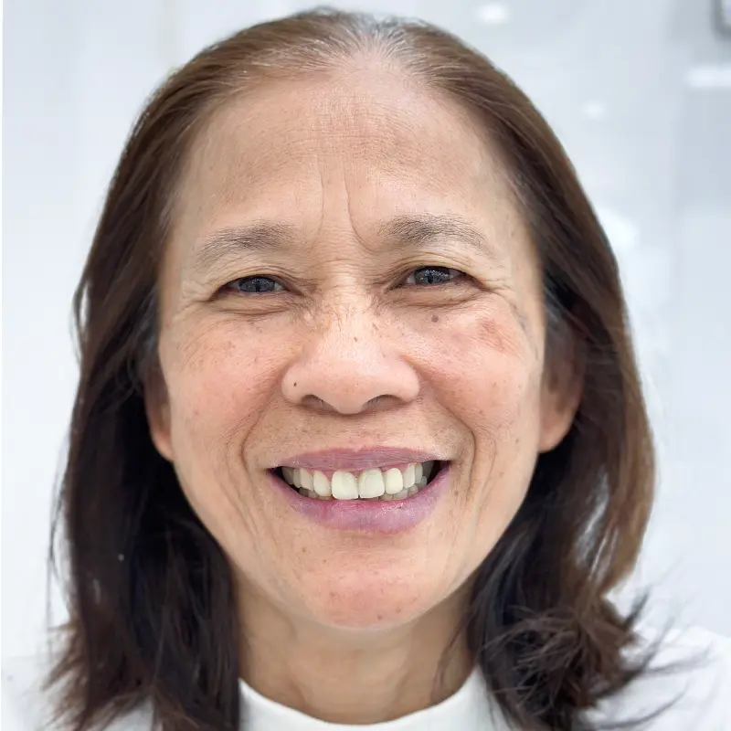 Ms. Huyen had cosmetic porcelain dental bridge