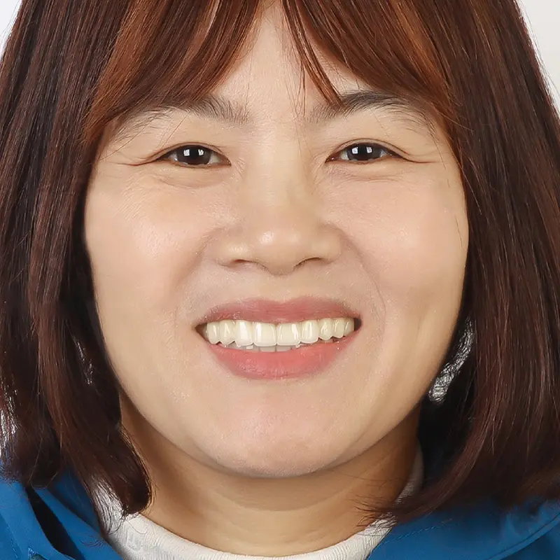 Ms. Tuyet had full jaw implant