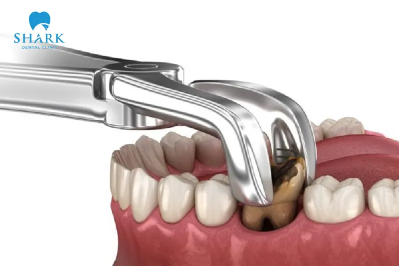 Tooth extraction helps prevent signs of infection and related complications