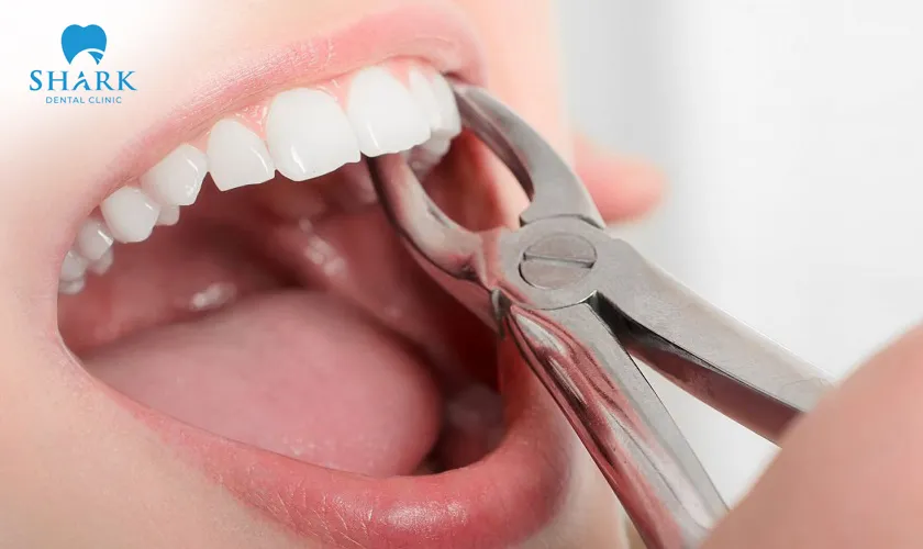 Healing and stabilization typically begin 1–2 days after the extraction