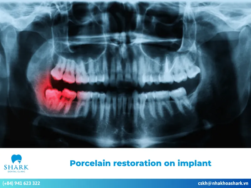 Porcelain restoration on implant