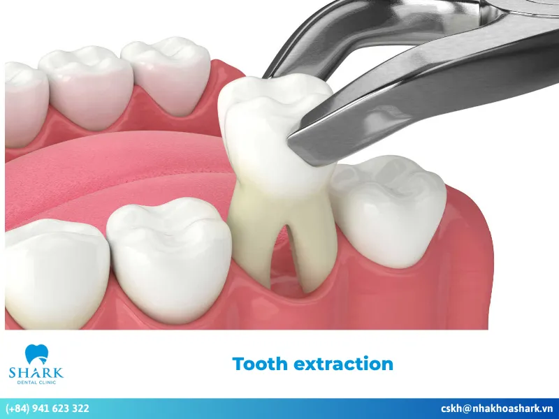 What is tooth extraction?