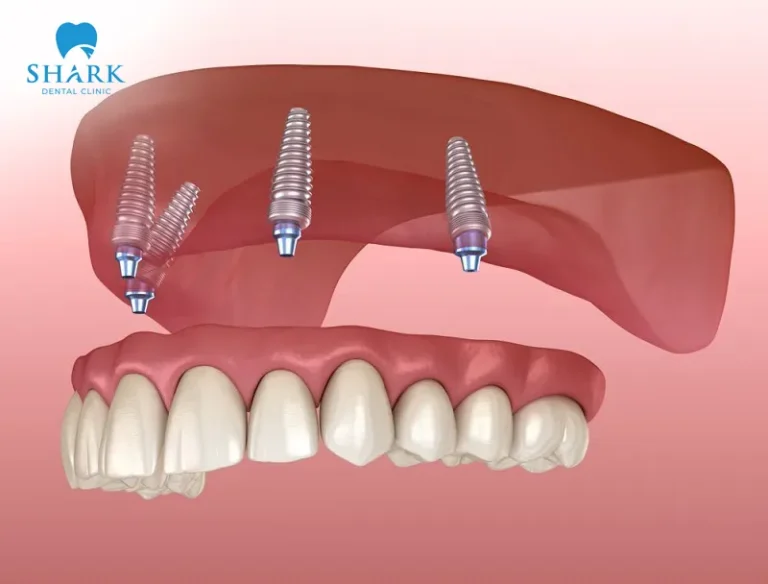 The All on X dental implant provides high safety, long-term effectiveness, and minimizes irritation