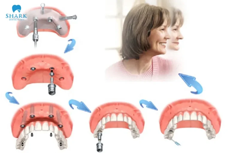 Successful All on X Implant treatment depends on multiple factors
