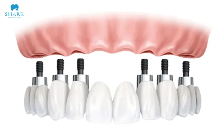 The cost of an All on X dental implant depends on various factors such as the dentist’s expertise and the chosen clinic