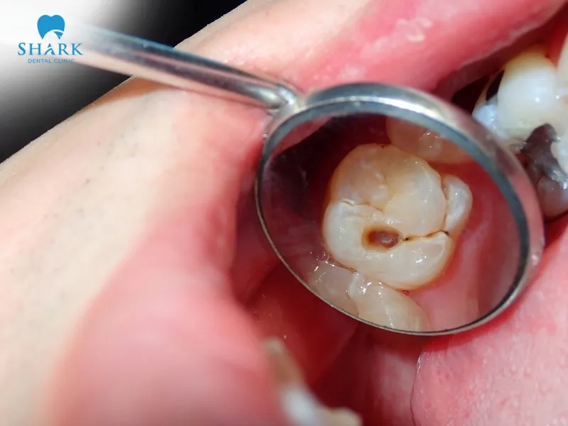 Depending on the actual severity of tooth decay, you can consult a dentist to consider options such as Veneer application, dental fillings, or porcelain crowns