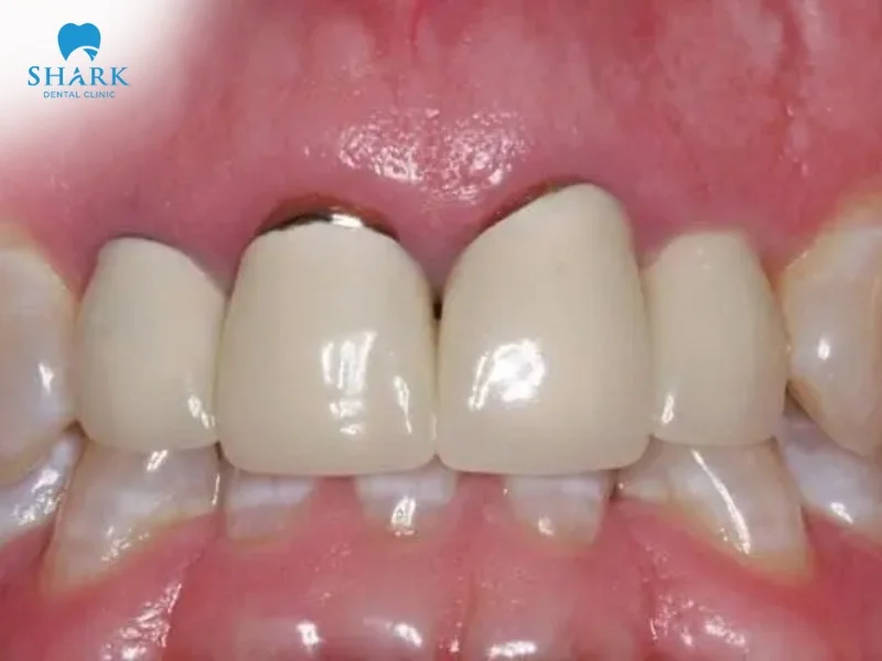 The dark gum line around the teeth after getting dental crowns can be removed with proper restoration at a dental clinic
